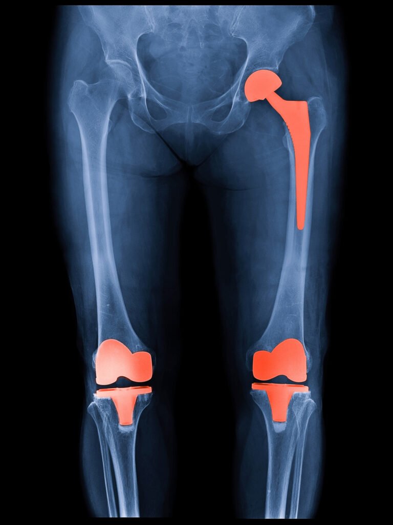 Joint Replacement Centre in Mumbai