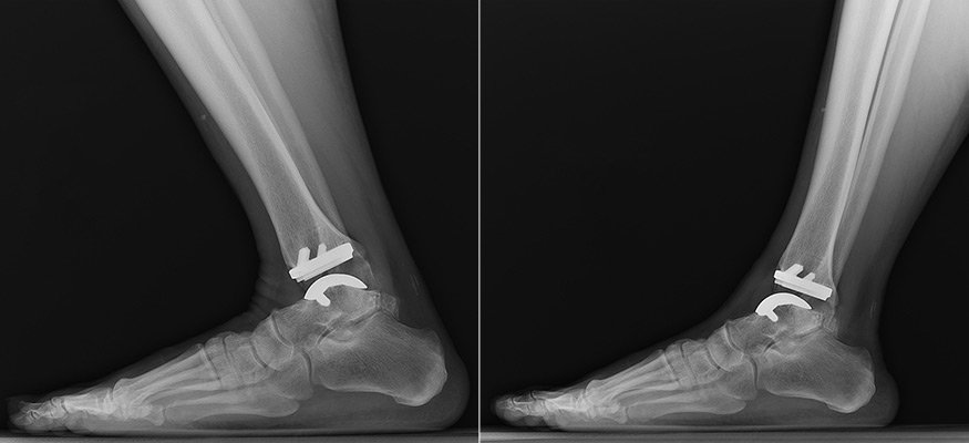 Joint Replacement Centre in Mumbai